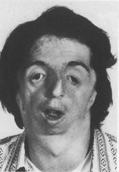 treacher-collins.jpg treacher-collins.jpg