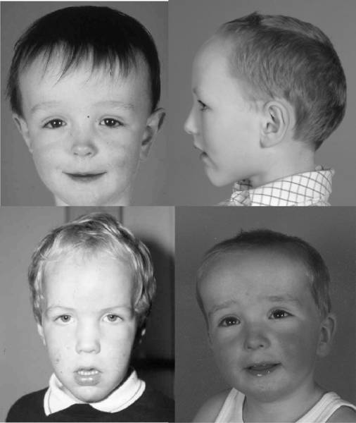 sotos_syndrome.jpg sotos_syndrome.jpg