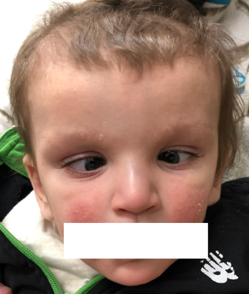 hadds_esotropia.png hadds_esotropia.png