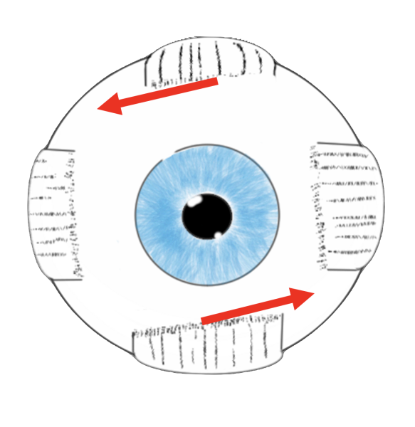 vertical_rectus_surgery_to_increase_incyclotorsion.png vertical_rectus_surgery_to_increase_incyclotorsion.png