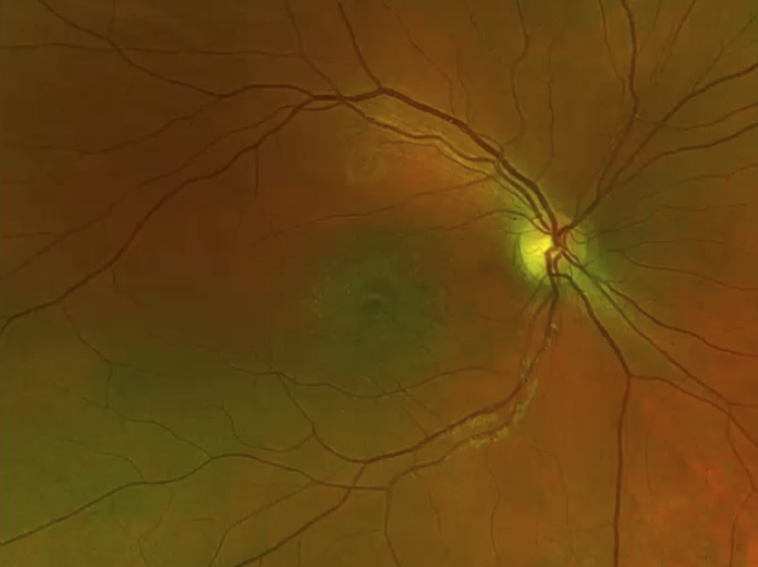 stargardt_dz_fundus.png stargardt_dz_fundus.png