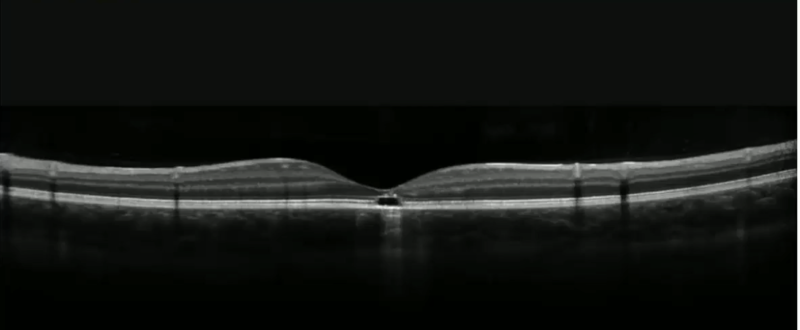 laser_maculopathy.png laser_maculopathy.png