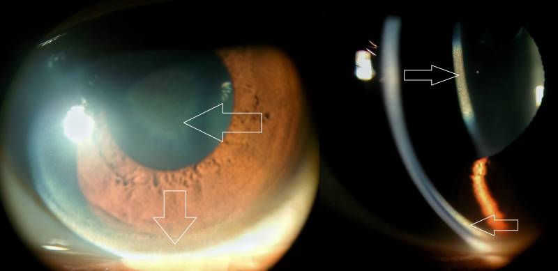 kf_ring_and_sunflower_cataract.jpg kf_ring_and_sunflower_cataract.jpg