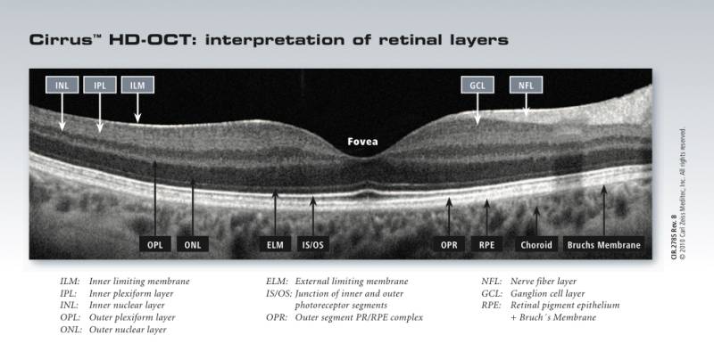 cirrus_oct_interpretion_of_retinal_layers.jpg cirrus_oct_interpretion_of_retinal_layers.jpg
