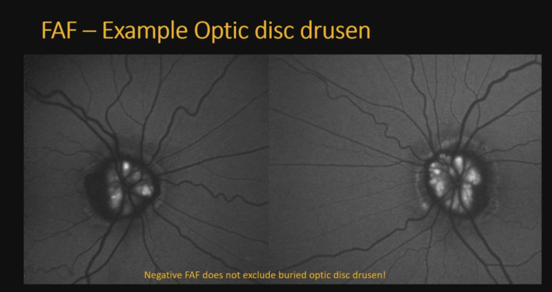 faf_on_drusen.png faf_on_drusen.png
