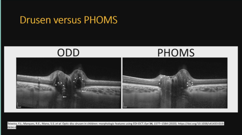 phoms_vs_on_drusen.png phoms_vs_on_drusen.png