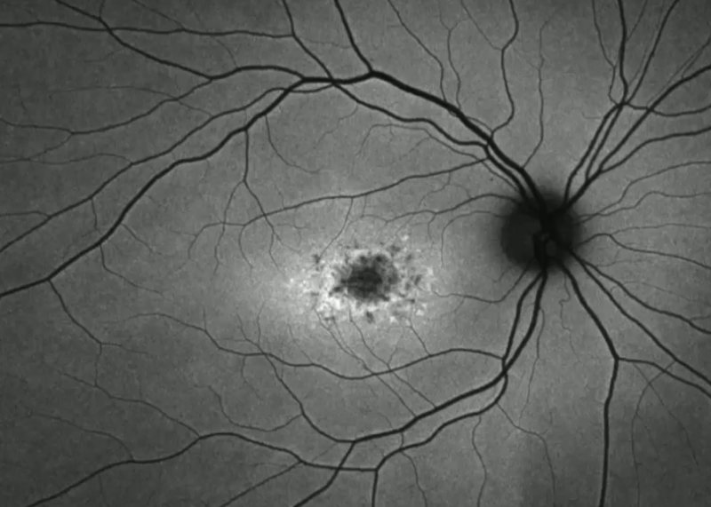 stargardt_dz_fundus_autofl1.png stargardt_dz_fundus_autofl1.png