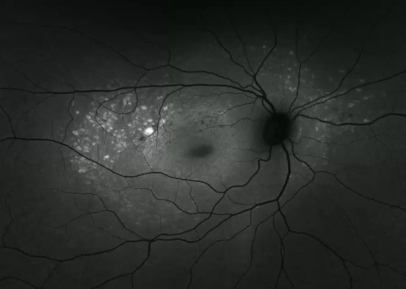 stargardt_dz_fundus_autofl2.png stargardt_dz_fundus_autofl2.png