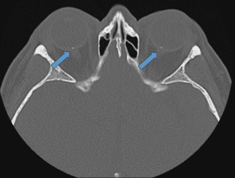 ct_scan_on_drusen.png ct_scan_on_drusen.png
