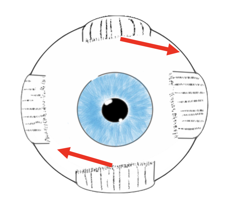 vertical_rectus_surgery_to_increase_excyclotorsion.png vertical_rectus_surgery_to_increase_excyclotorsion.png