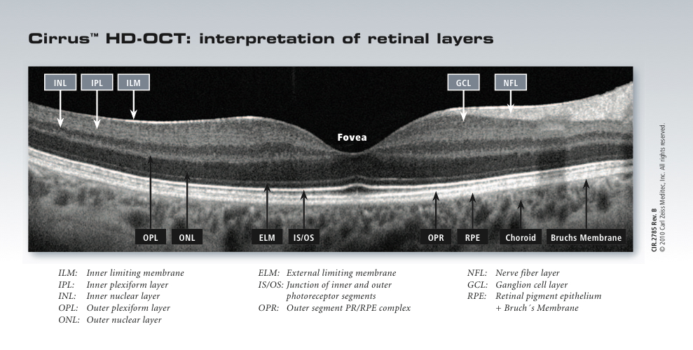 Cirrus OCT Interpretation of Retinal Layers